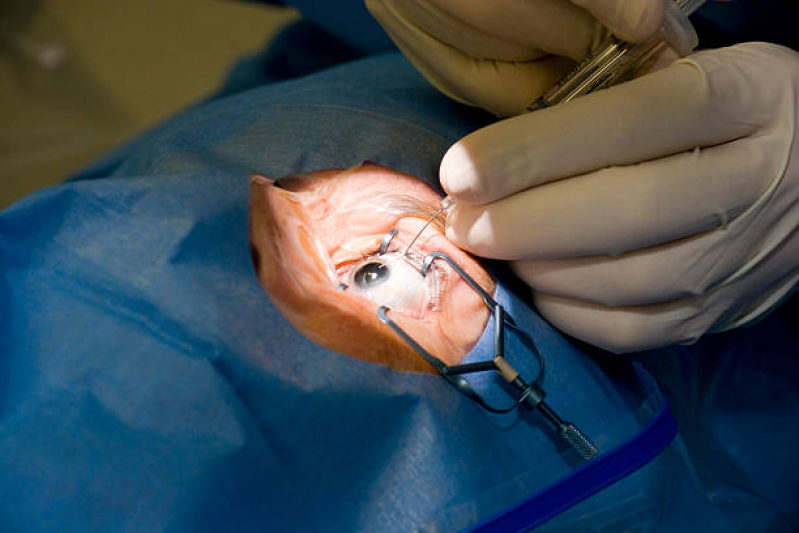 Cirurgia para Catarata Lapa - Cirurgia de Catarata Vila Clementino