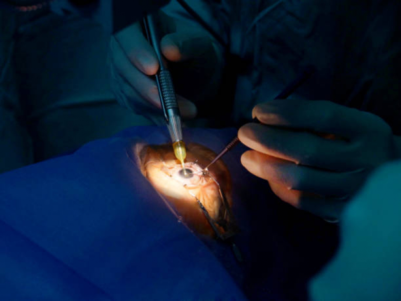 Clínica Que Faz Cirurgia de Lente no Olho Próximo a Travessa Caligasta - Cirurgia de Catarata Vila Clementino