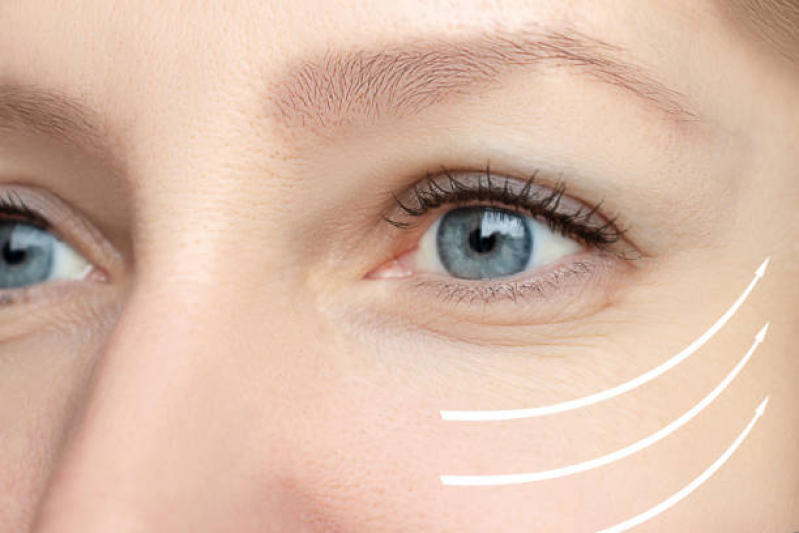 Onde Fazer Tratamento para Rugas ao Redor dos Olhos Brooklin - Tratamento para Rugas na Testa