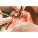 cirurgia das pálpebras Vila Argentina