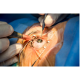 cirurgia lente intra ocular clínica Próximo a Puc