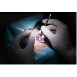 cirurgia para bolsas de gordura nos olhos clínica São Paulo