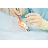 cirurgia para correção de astigmatismo clínica Sacoma