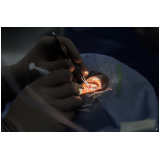 cirurgia para facectomia com implante de lente marcar Moema
