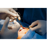 cirurgia para facectomia com implante de lente Vila Romana