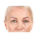 cirurgia plástica para bolsa dos olhos clínica Próximo a praça Ciríaco Grisanti