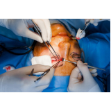 cirurgia plástica para bolsa nos olhos clínica Vila Mariana
