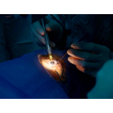 Cirurgia para Cataratas a Laser