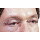 clínica especialista em procedimento para bolsas de gordura nos olhos Emboabas