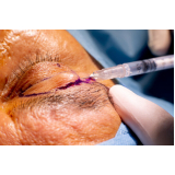 clínica especialista em procedimento para flacidez dos olhos Bahia
