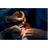 clínica que faz cirurgia para facectomia com implante de lente Parque Residencial da Lapa