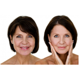 tratamento para revitalização facial Ipiranga