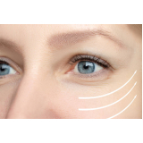 Tratamento para Rugas ao Redor dos Olhos