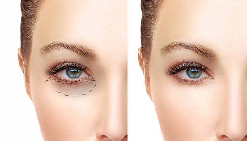 Tratamento para Rugas Marcar Vila Anastácio - Tratamento para Rugas ao Redor dos Olhos