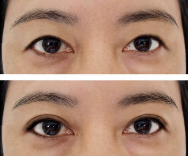 Tratamento para Rugas nos Olhos Mooca - Tratamento para Rugas na Testa